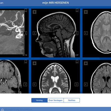 Optic Nerve - Preview